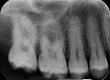 Fig.2 - Radiografia periapicale in rapporto 1:1. Permette di valutare per bene questi 4 denti in tutti i particolari.(Officina)