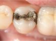 Vecchio restauro in amalgama su dente 15. La paziente chiede la rimozione della amalgama e il restauro del dente in composito.