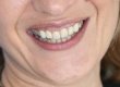 Foto iniziale. Gummy smile e non idoneo disegna estetico delle corone dentali. 
